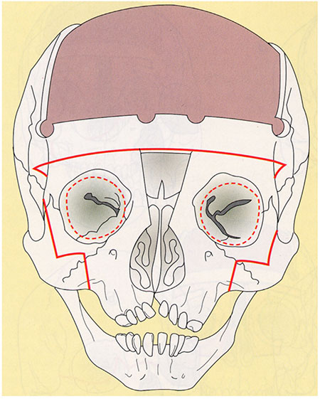 Figur 3. Facial bipartition.
